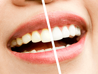 Teeth Whitening